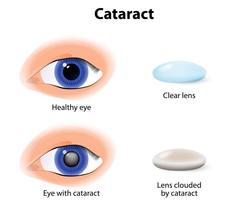 Reading Lights for Cataracts